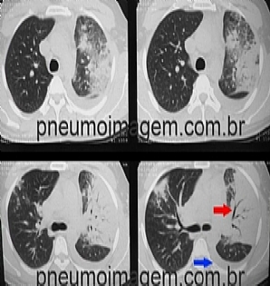ALIMENTAÇÃO ENTERAL E O RISCO DE PNEUMONIA EM DOENTES CRÍTICOS ALIMENTAÇÃO ENTERAL E O RISCO DE PNEUMONIA EM DOENTES CRÍTICOS
